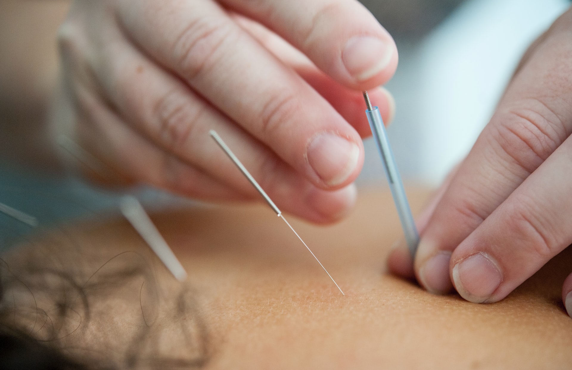 Acupuncture Beirut Lebanon